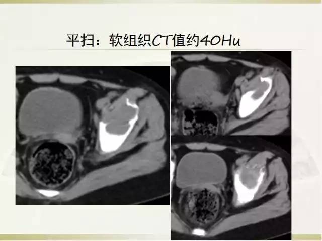 【病例】髂骨嗜酸性肉芽肿1例