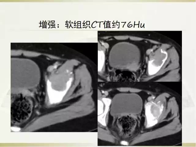 【病例】髂骨嗜酸性肉芽肿1例