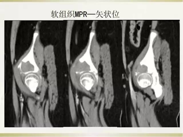 【病例】髂骨嗜酸性肉芽肿1例