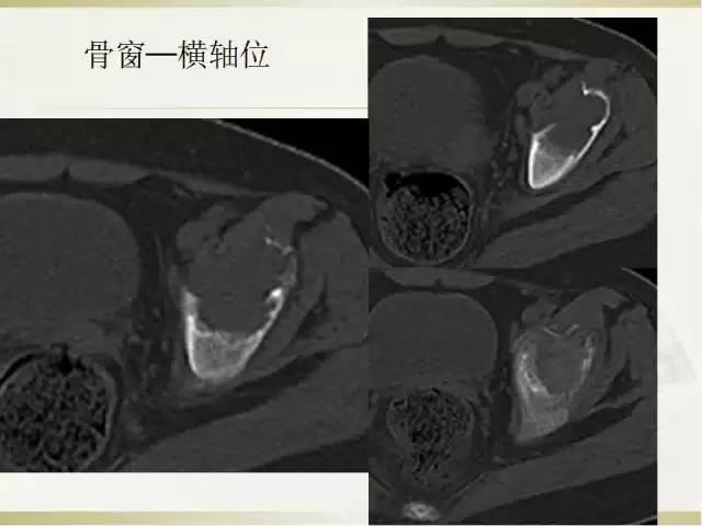 【病例】髂骨嗜酸性肉芽肿1例
