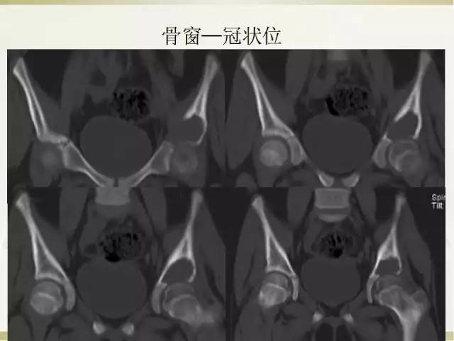 【病例】髂骨嗜酸性肉芽肿1例