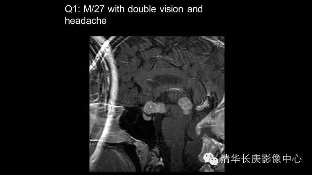 【病例】生殖细胞瘤1例MR影像表现