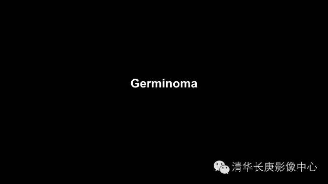 【病例】生殖细胞瘤1例MR影像表现