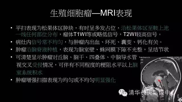 【病例】生殖细胞瘤1例MR影像表现