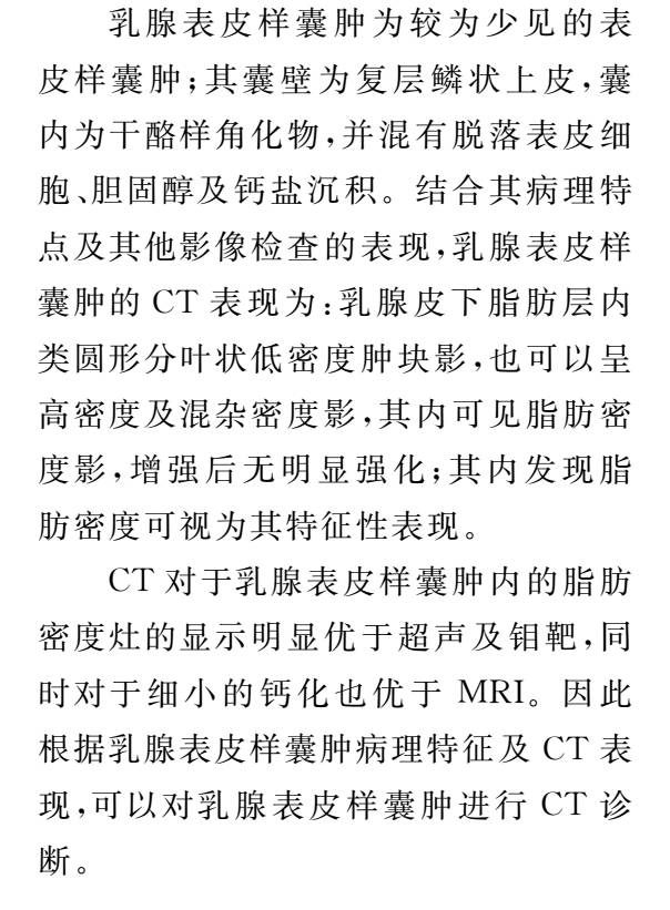 【病例】乳腺表皮样囊肿1例CT影像特点