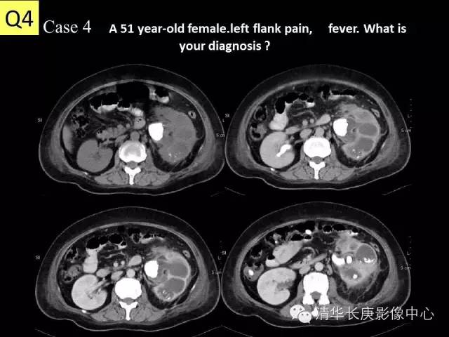 【病例】黄色肉芽肿性肾盂肾炎1例CT影像表现