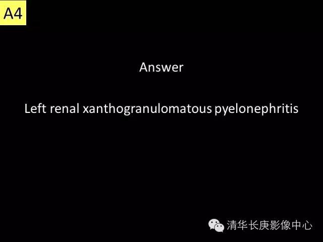 【病例】黄色肉芽肿性肾盂肾炎1例CT影像表现