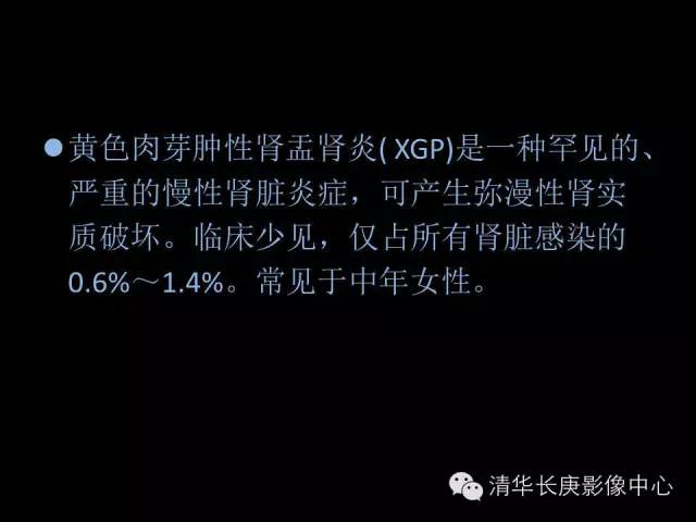 【病例】黄色肉芽肿性肾盂肾炎1例CT影像表现