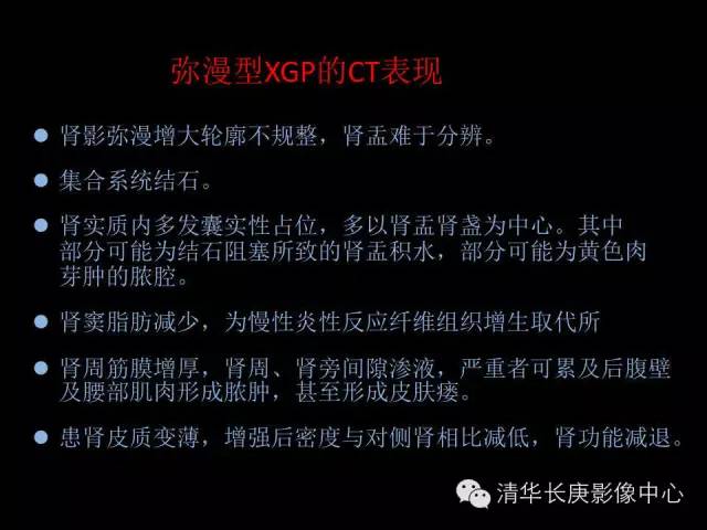 【病例】黄色肉芽肿性肾盂肾炎1例CT影像表现