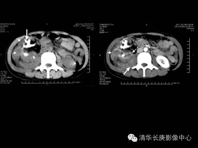 【病例】黄色肉芽肿性肾盂肾炎1例CT影像表现