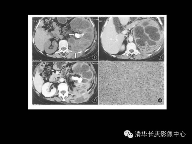 【病例】黄色肉芽肿性肾盂肾炎1例CT影像表现