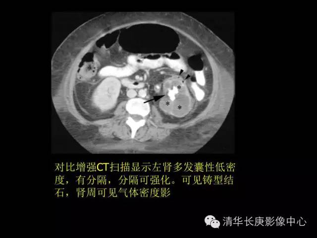 【病例】黄色肉芽肿性肾盂肾炎1例CT影像表现