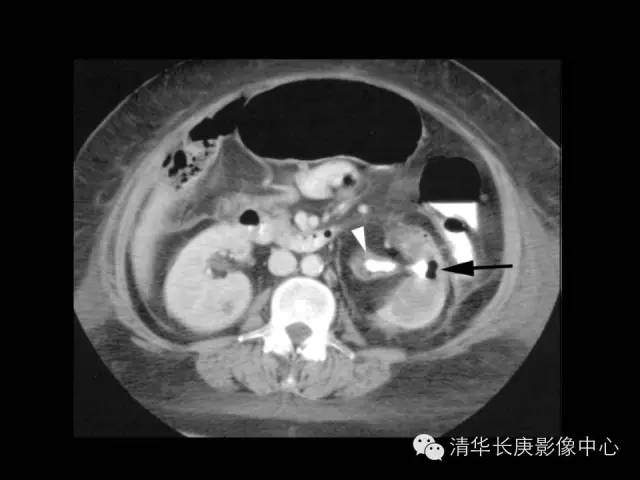 【病例】黄色肉芽肿性肾盂肾炎1例CT影像表现