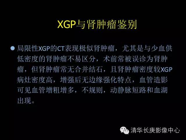 【病例】黄色肉芽肿性肾盂肾炎1例CT影像表现
