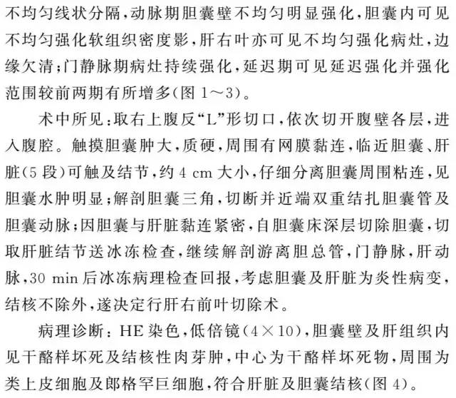【病例】肝脏及胆囊结核1例CT影像表现