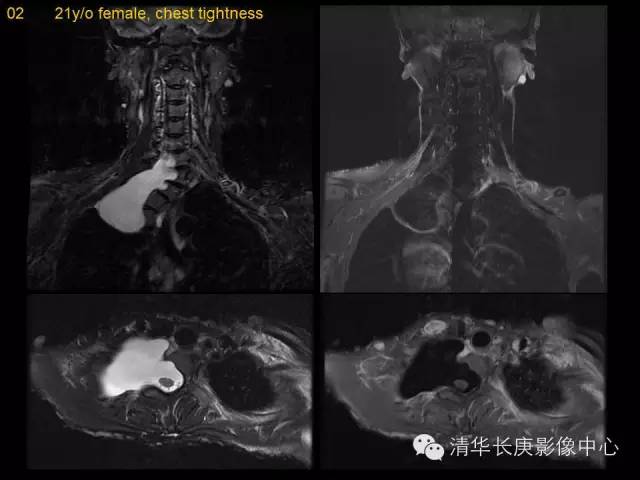 【病例】神经纤维瘤病1例MR影像表现