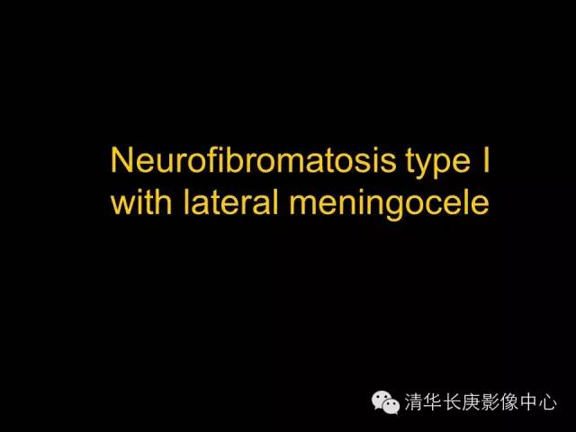 【病例】神经纤维瘤病1例MR影像表现