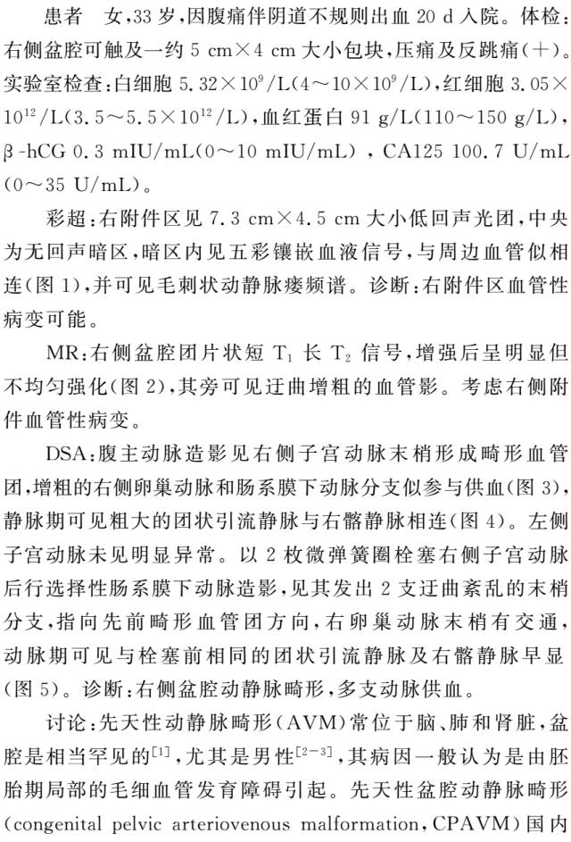 【病例】先天性盆腔动静脉畸形1例影像表现 【病例】先天性盆腔动静脉畸形1例影像表现
