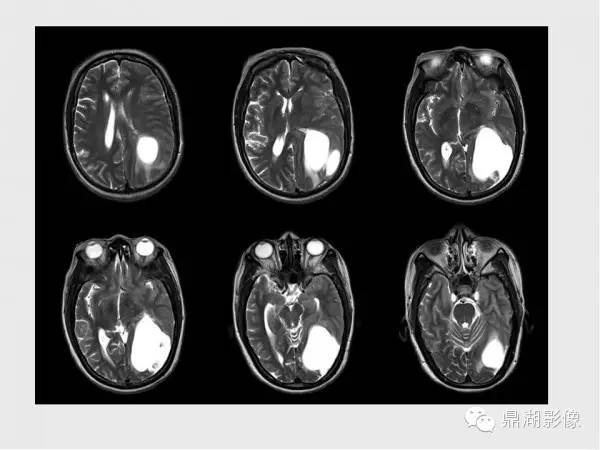 【病例】囊性脑膜瘤1例MR影像表现