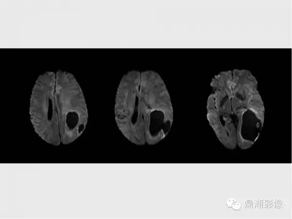 【病例】囊性脑膜瘤1例MR影像表现