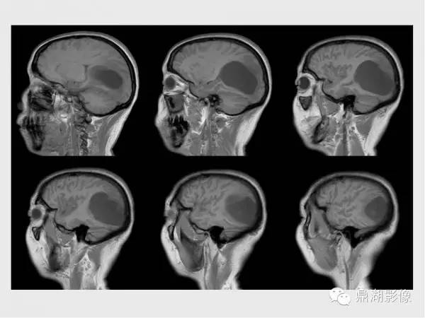 【病例】囊性脑膜瘤1例MR影像表现