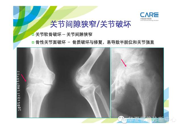 【PPT】骨肌系统影像学基本征象的再认识