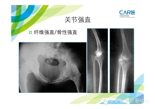 【PPT】骨肌系统影像学基本征象的再认识