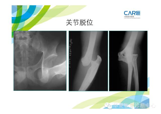 【PPT】骨肌系统影像学基本征象的再认识