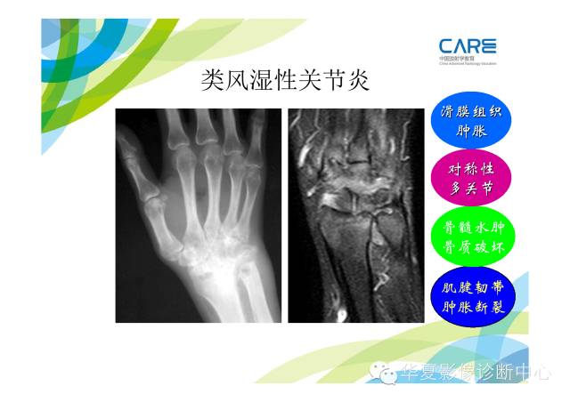 【PPT】骨肌系统影像学基本征象的再认识