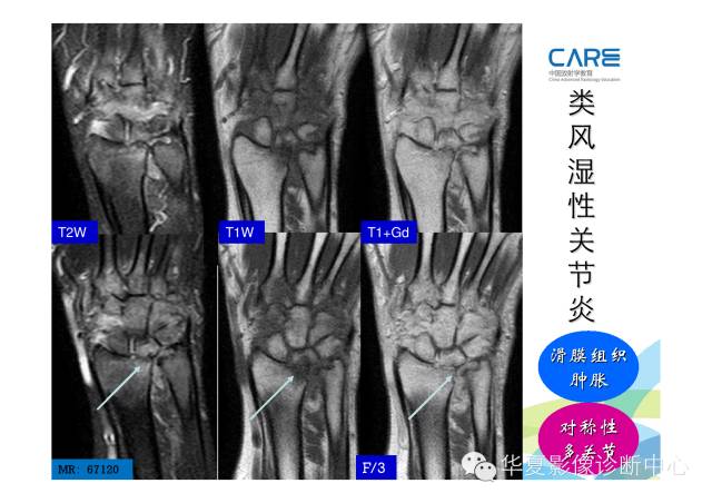 【PPT】骨肌系统影像学基本征象的再认识