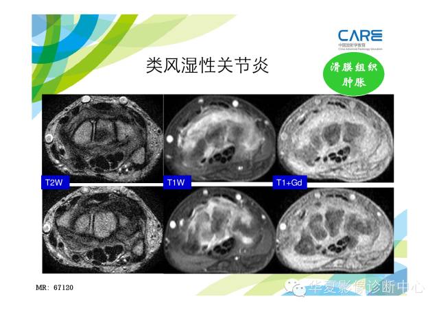 【PPT】骨肌系统影像学基本征象的再认识