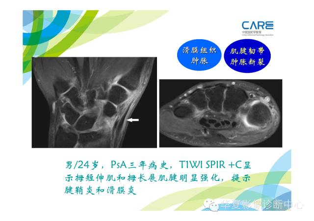 【PPT】骨肌系统影像学基本征象的再认识