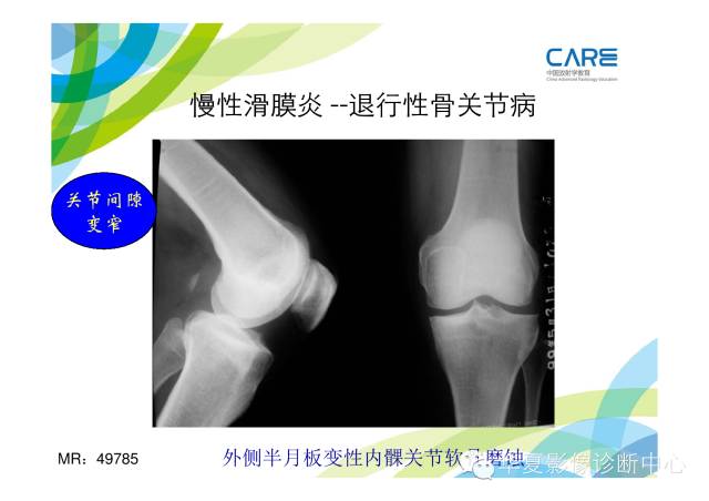 【PPT】骨肌系统影像学基本征象的再认识