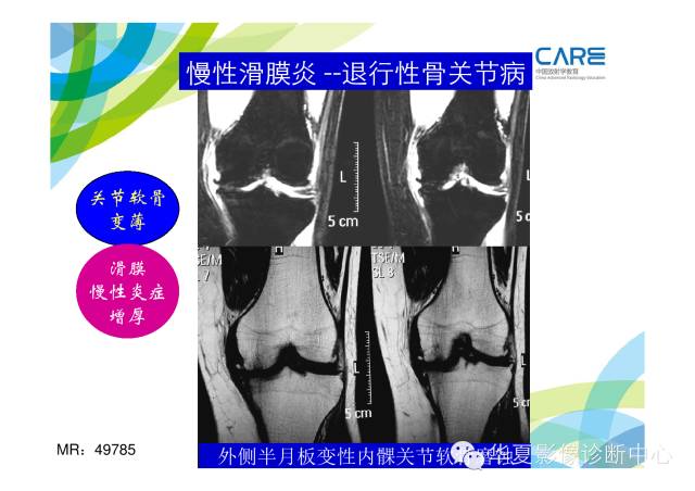 【PPT】骨肌系统影像学基本征象的再认识