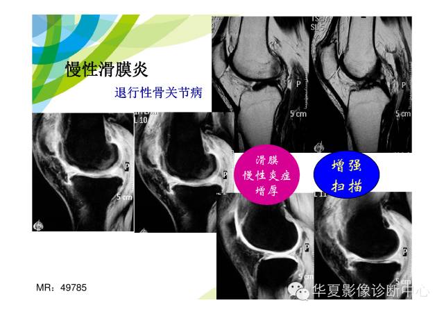【PPT】骨肌系统影像学基本征象的再认识