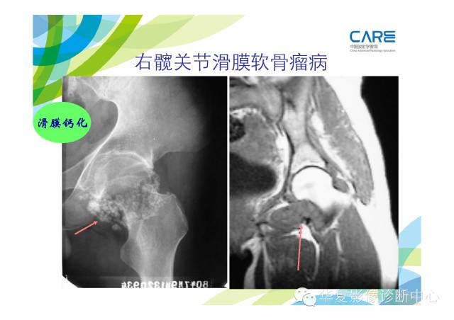 【PPT】骨肌系统影像学基本征象的再认识