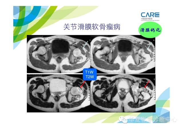 【PPT】骨肌系统影像学基本征象的再认识