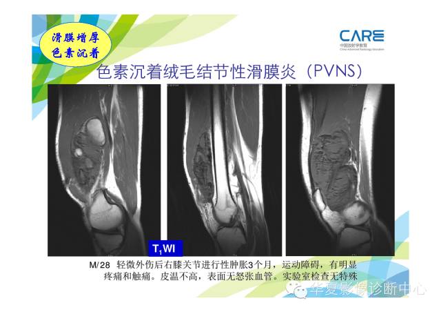 【PPT】骨肌系统影像学基本征象的再认识