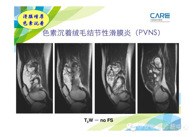 【PPT】骨肌系统影像学基本征象的再认识