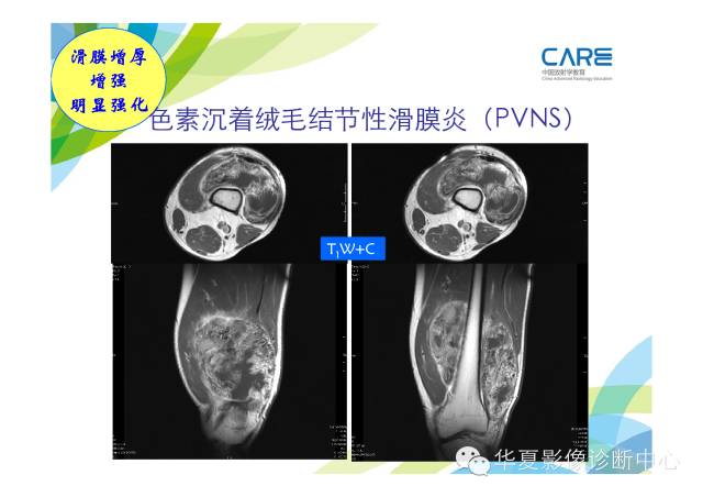 【PPT】骨肌系统影像学基本征象的再认识