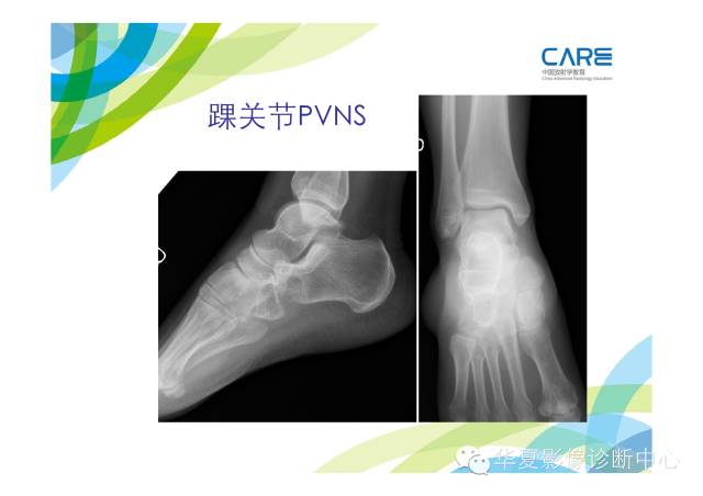【PPT】骨肌系统影像学基本征象的再认识