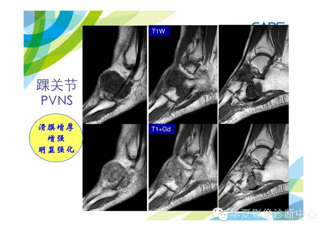 【PPT】骨肌系统影像学基本征象的再认识
