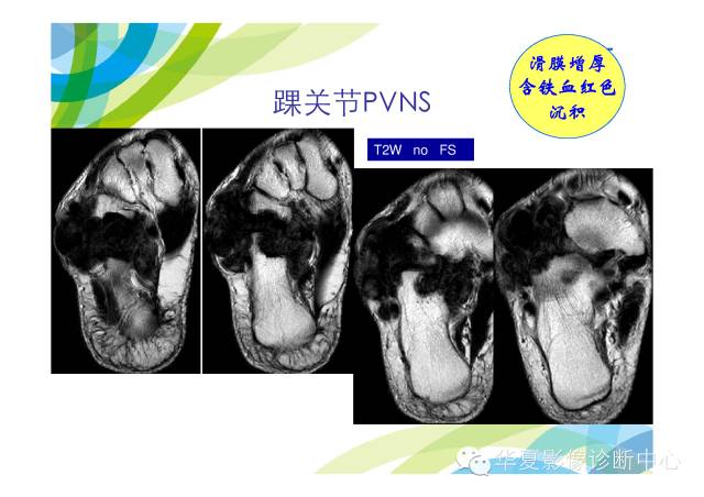 【PPT】骨肌系统影像学基本征象的再认识