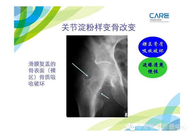 【PPT】骨肌系统影像学基本征象的再认识