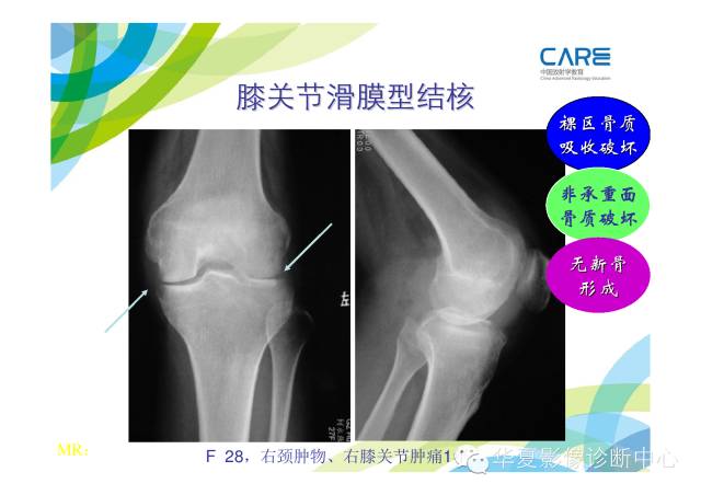 【PPT】骨肌系统影像学基本征象的再认识
