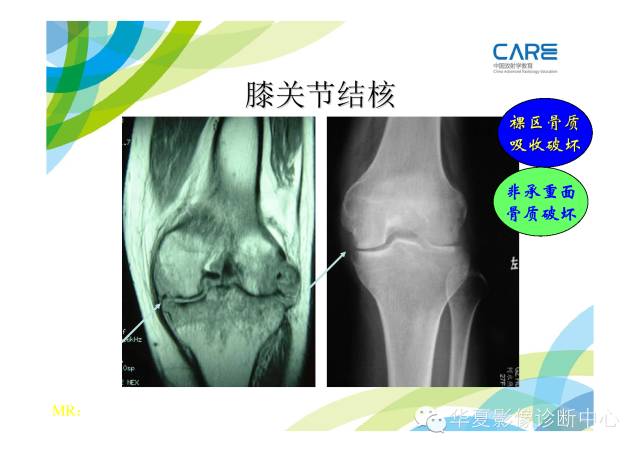 【PPT】骨肌系统影像学基本征象的再认识