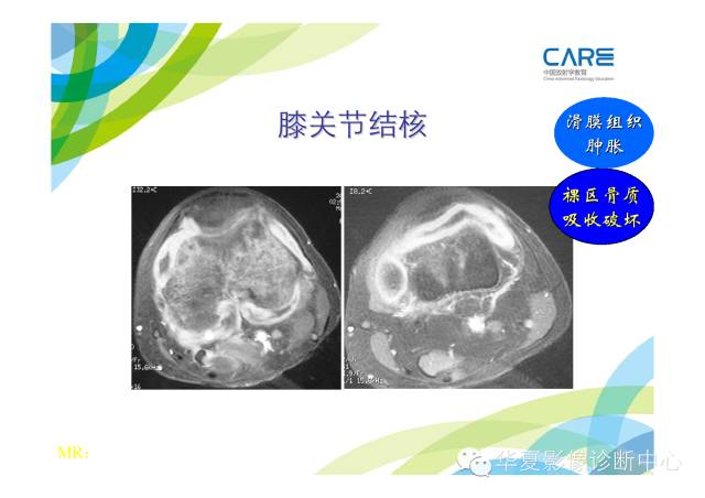 【PPT】骨肌系统影像学基本征象的再认识