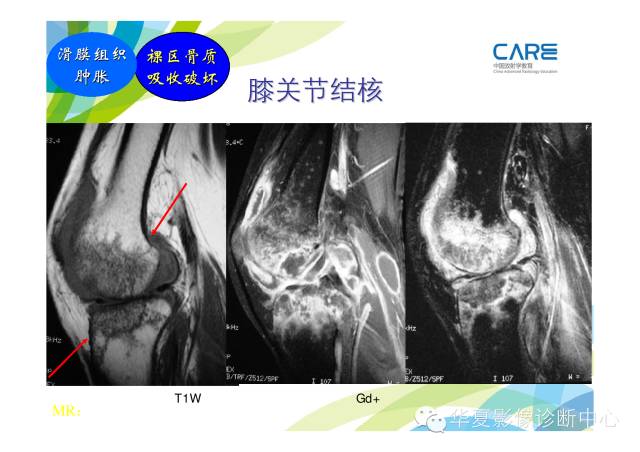 【PPT】骨肌系统影像学基本征象的再认识