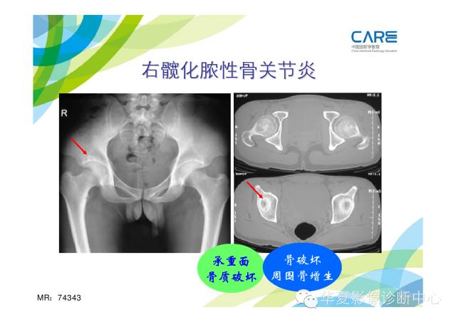 【PPT】骨肌系统影像学基本征象的再认识