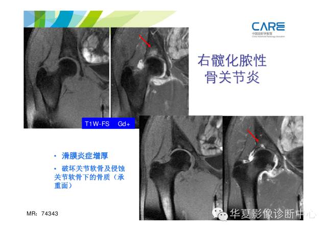 【PPT】骨肌系统影像学基本征象的再认识